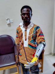 Discover How This Ingenious Individual Created Africa’s First AI Prosthetic Arm