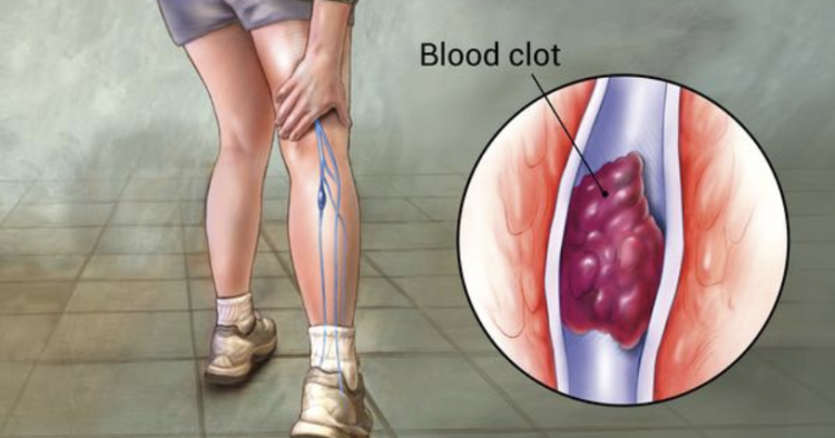 Deep Vein Thrombosis: The Silent Killer