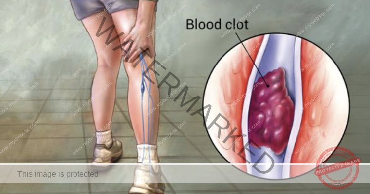 Deep Vein Thrombosis: The Silent Killer