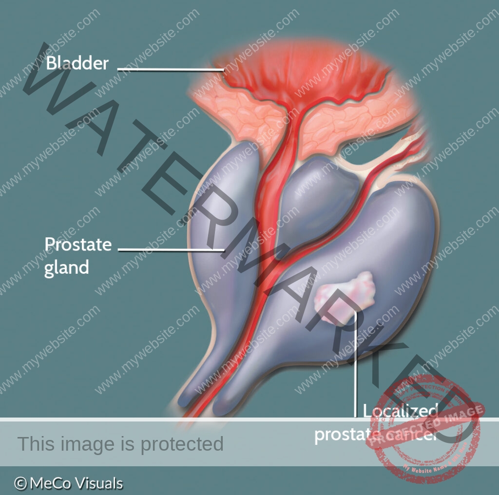 Know the risk: Early detection is key in prostate cancer development