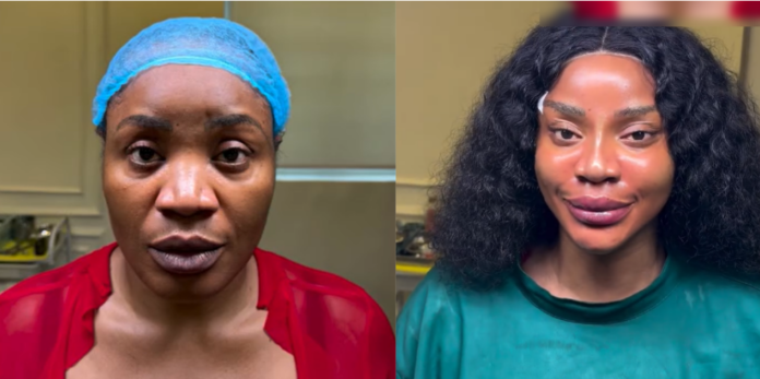 Actress Uche Ogbodo Undergoes Facial Rejuvenation Following Liposuction Procedure Actress Uche Ogbodo Undergoes Facial Rejuvenation Following Liposuction Procedure